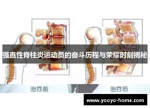 强直性脊柱炎运动员的奋斗历程与荣耀时刻揭秘